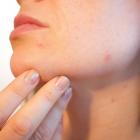 Magnetiseur guingamp peau zona eczema cicatrisation verrue acne psoriasis ulcere variqueux kystes mycoses urticaire demangeaisons